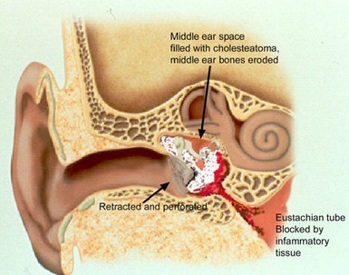 How Does it Occur? - Cholesteatoma How Does it Occur? - Cholesteatoma