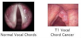Hoarseness Hoarseness Examples