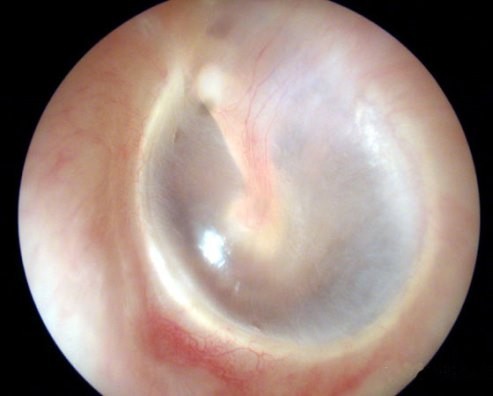 Ear Tubes Canton, GA Ear Tubes Canton, GA