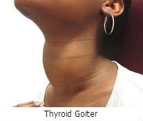 Thyroid Goiter Treatment in Canton, GA Thyroid Goiter Treatment in Canton, GA