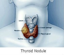 Thyroid Nodule Treatment in Canton, GA Thyroid Nodule Treatment in Canton, GA