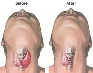 Thyroid Surgery Thyroid Surgery