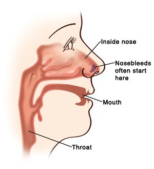 Nosebleed Diagram Nosebleed Diagram