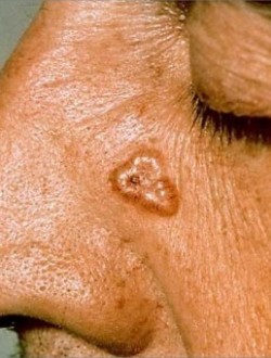 Basal Cell Carcinoma Treatment Canton, GA Basal Cell Carcinoma Treatment Canton, GA