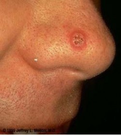 Squamous Cell Carcinoma Treatment Canton, GA Squamous Cell Carcinoma Treatment Canton, GA