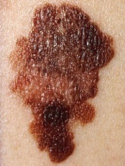 Malignant Melanoma Treatment Canton, GA Malignant Melanoma Treatment Canton, GA